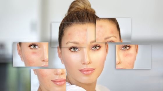 Behind The Breakout: Understanding The Emotional Impact Of Acne