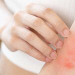 What is the treatment for allergic contact dermatitis?