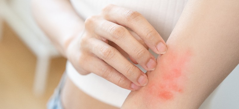 What is the treatment for allergic contact dermatitis?
