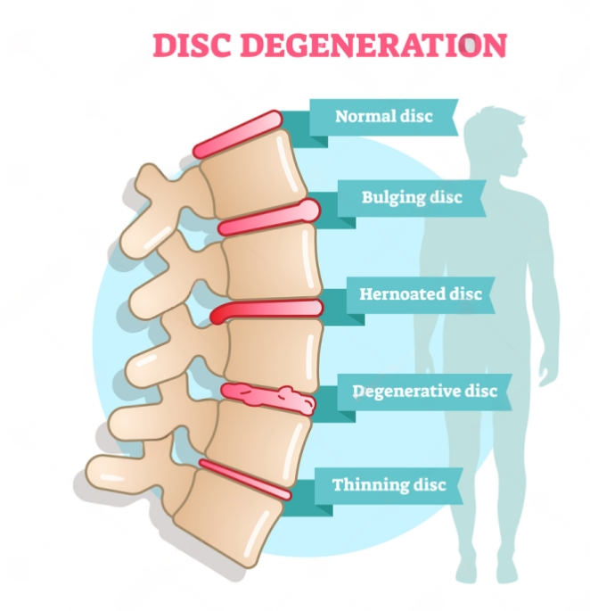How to Choose the Right Treatment for Your Disc Bulge