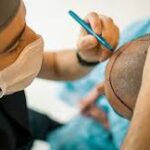 Best Hair Transplant in Lahore – Top Clinics and Techniques