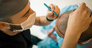 Best Hair Transplant in Lahore – Top Clinics and Techniques