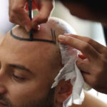 Natural Hair Restoration: Hair Transplants in Abu Dhabi