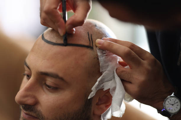 Natural Hair Restoration: Hair Transplants in Abu Dhabi